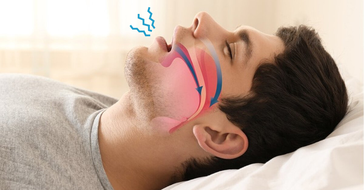 Tidur Mendengkur dan Konsekuensi terhadap Kesehatan