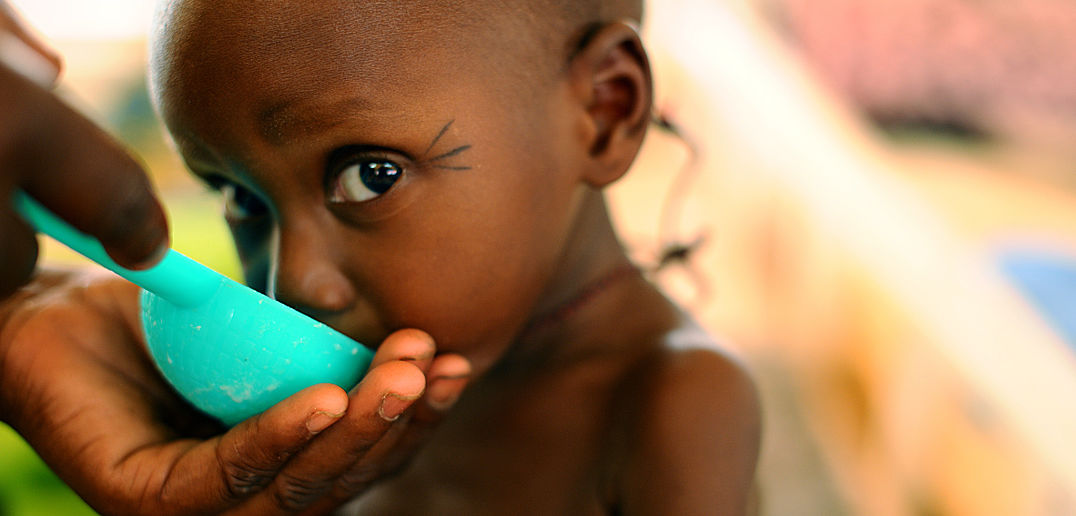 Gizi Buruk Bukan Hanya Akibat dari Rendahnya Asupan Makanan