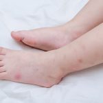 Bagaimana Menghilangkan Bekas Gigitan Nyamuk dengan Cepat ?