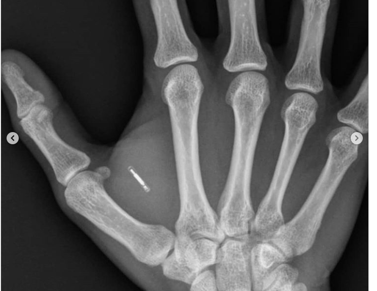 Lebih Dari 4000 Orang di Swedia Memasang Chip Di Tangan, Begini Penampakannya