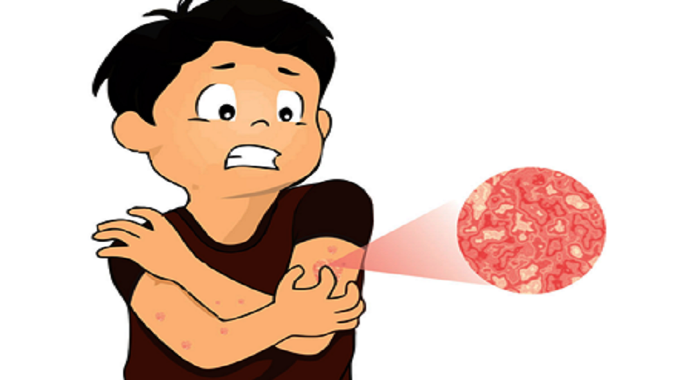 Pernah Cacar Air? Harus Waspada Cacar Ular Atau Herpes Zoster